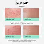Redness Soothing Azelaic Acid Serum